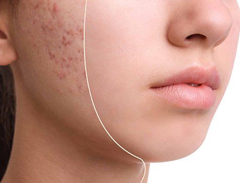 acne scars treatment in dubai