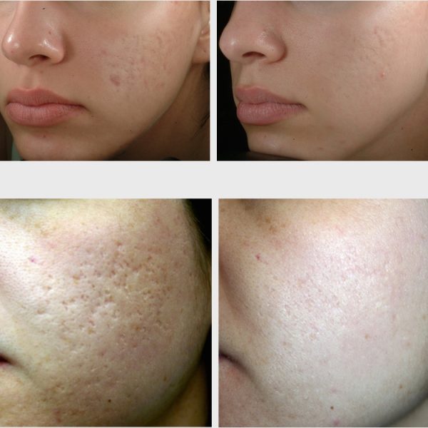 acne scar treatment benefits