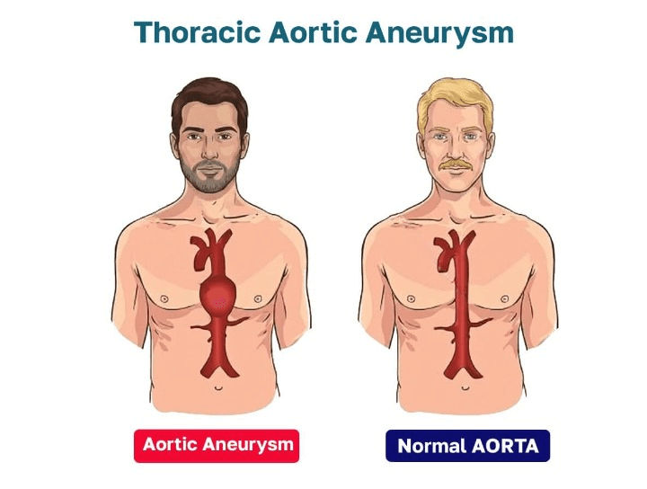 Thoracic Aortic Aneurysm