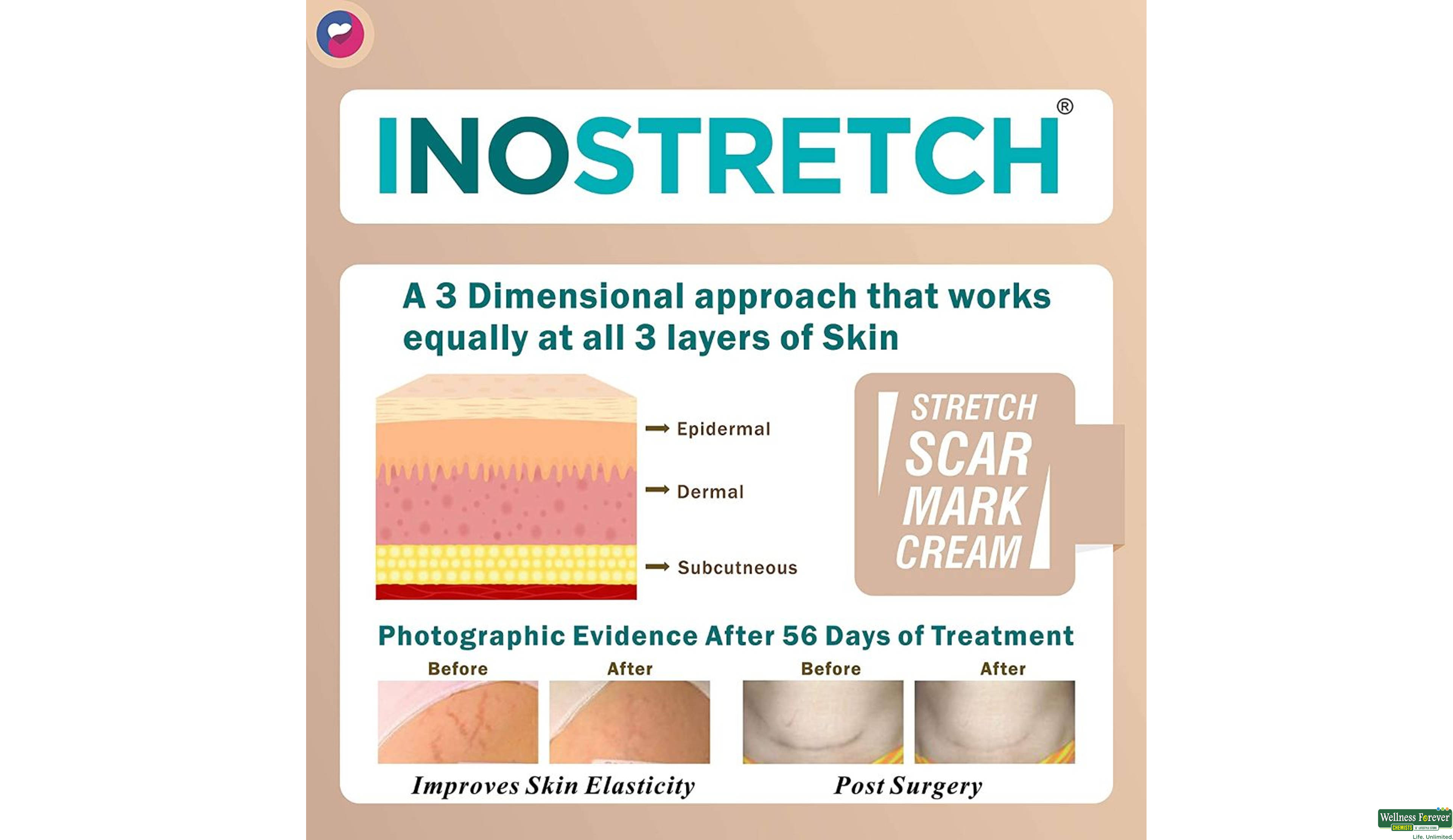 INOSTRETCH STRETCH MARK CREAM 60GM- 5, 60GM, 