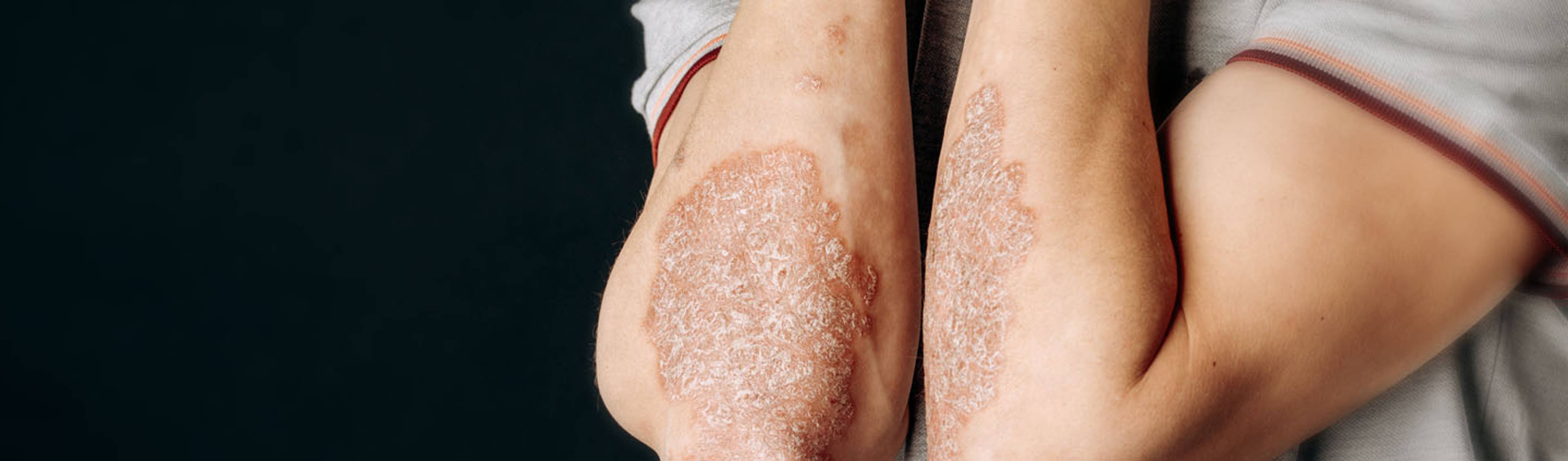 COMMOM SKIN DISORDERS-image