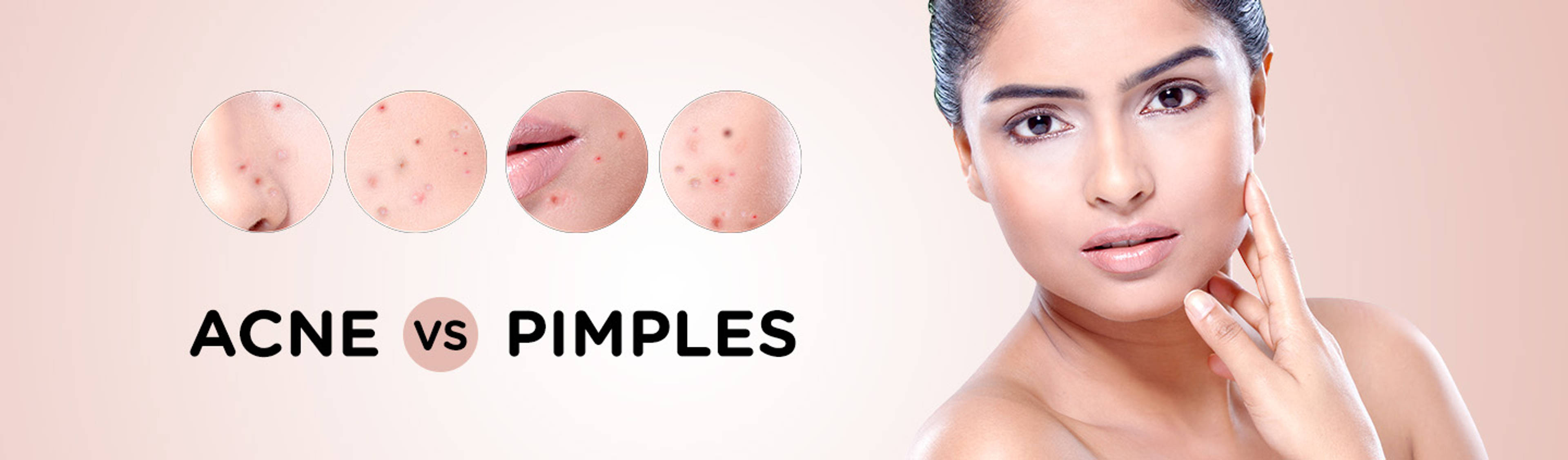 DIFFERENCE BETWEEN ACNE AND PIMPLES-image