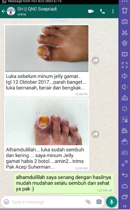  Obat  Alami Luka Borok Akibat  Diabetes  Tanpa Harus Operasi