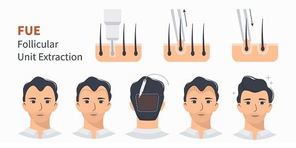 Follicular Unit Extraction (FUE)