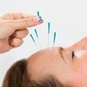 Acupuncture 