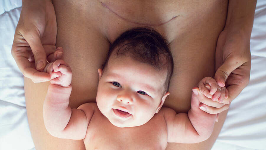 Typische Beschwerden: Kaiserschnitt-Narbe