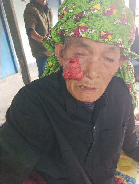 Dua Tahun Terisolasi dengan Tumor, Kakek Indrayub Akhirnya Dievakuasi LP2M Mitra Sehati ke RSUD Soedjono