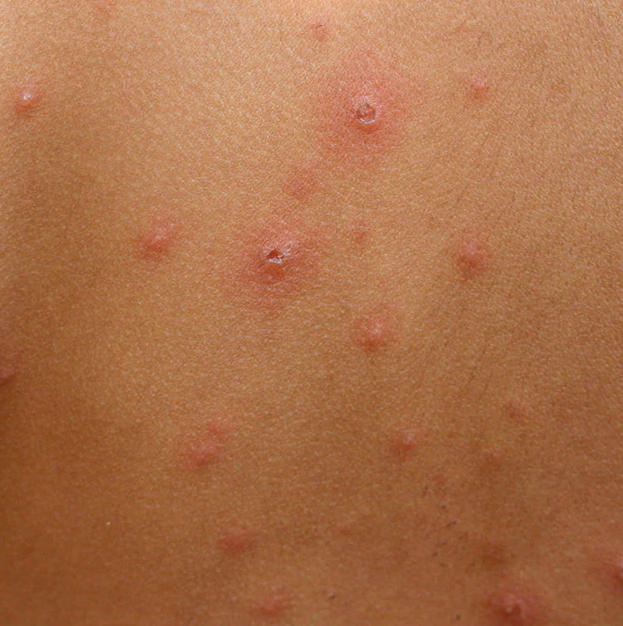 Chickenpox