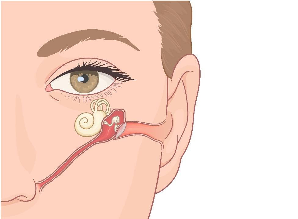 Eustachian Tube Blockage