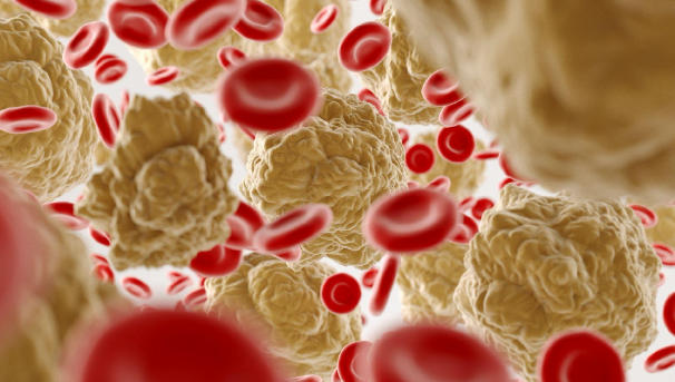 High cholesterol risks