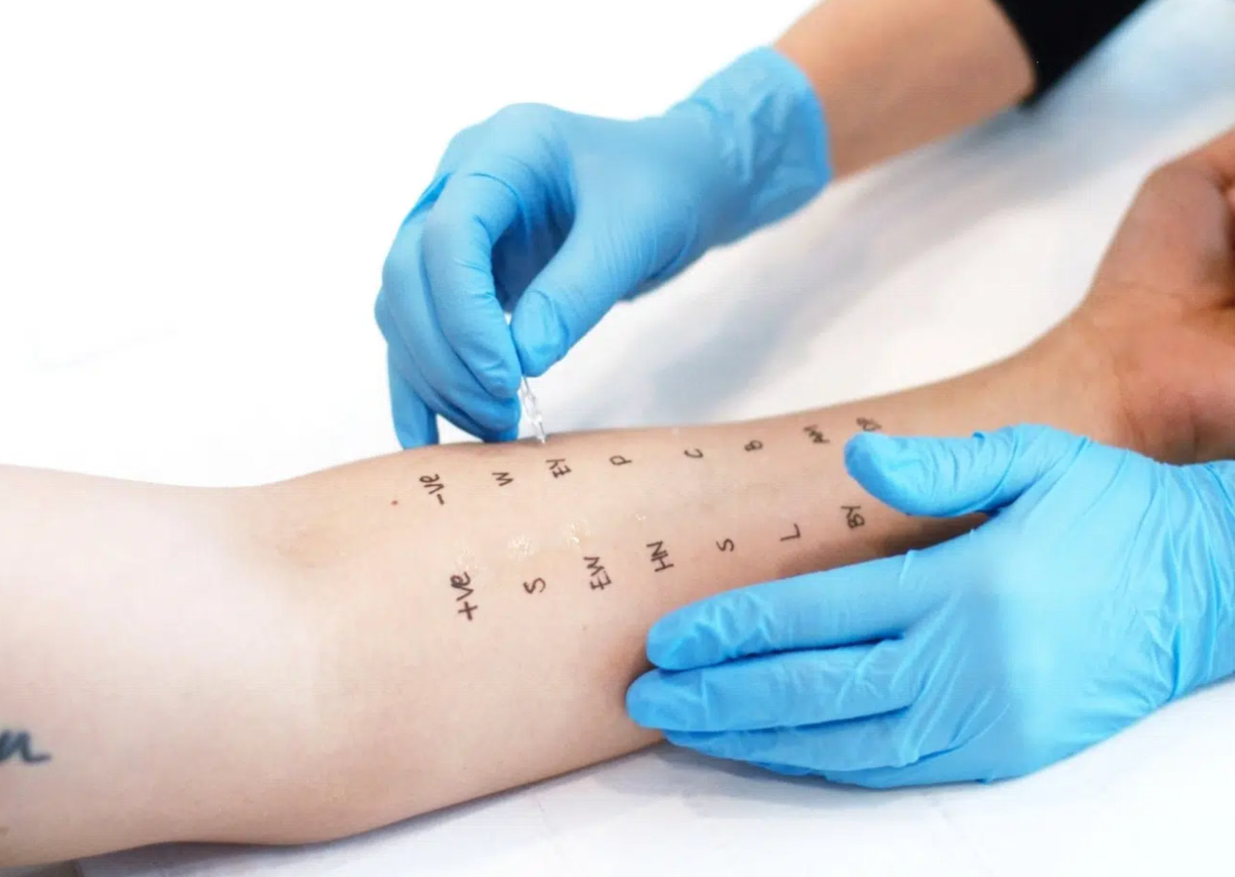 Skin Prick Allergy Test