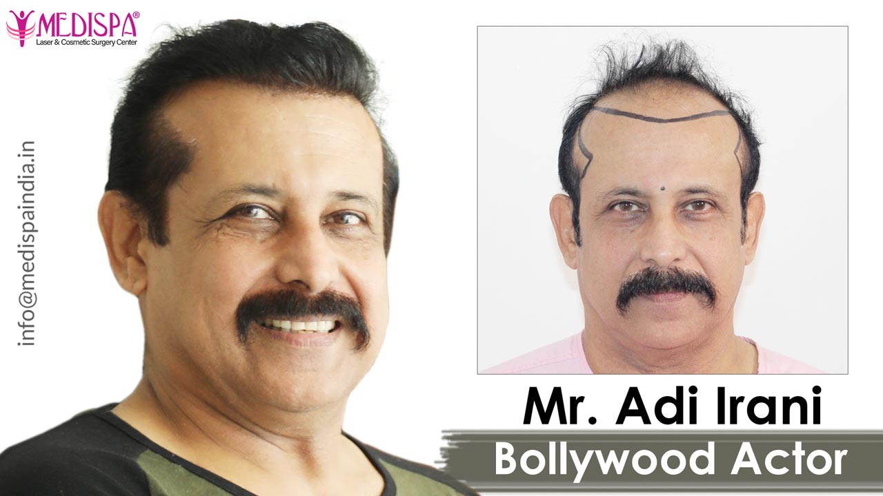 hair transplant female celebrities in india