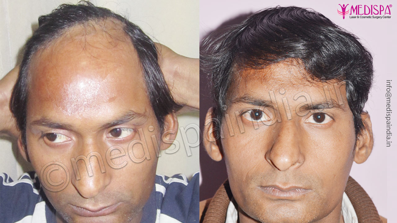 Burn Hair Transplant Photo Gallery Hair Transplant Dubai Cost