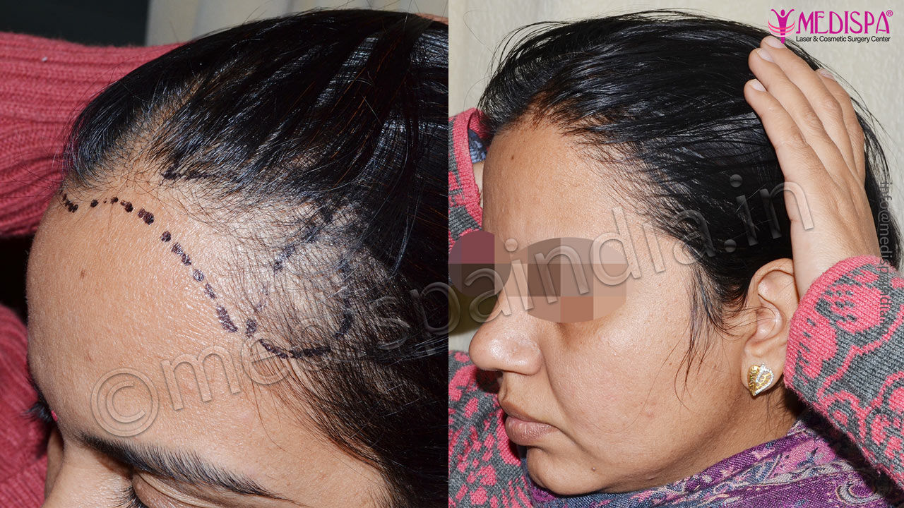 female hair transplants result | Hair Transplant Dubai Cost female hair transplants result | Hair Transplant Dubai Cost