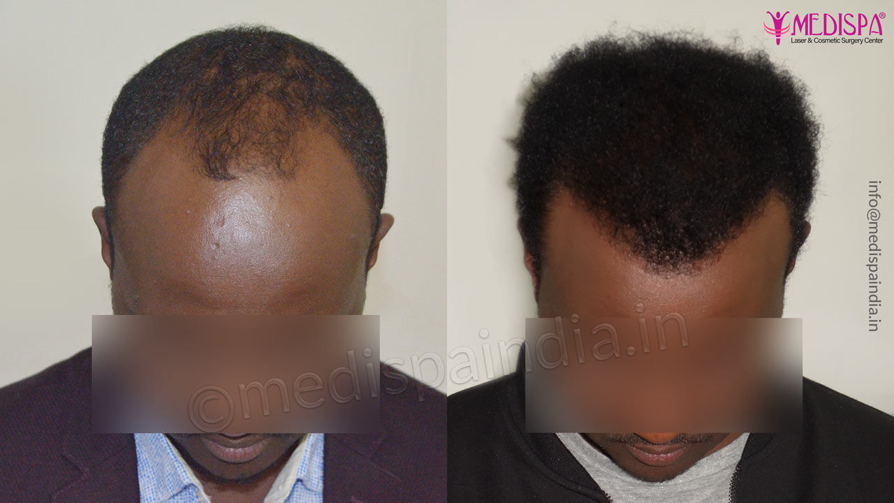african hair transplant results | Hair Transplant Dubai Cost african hair transplant results | Hair Transplant Dubai Cost