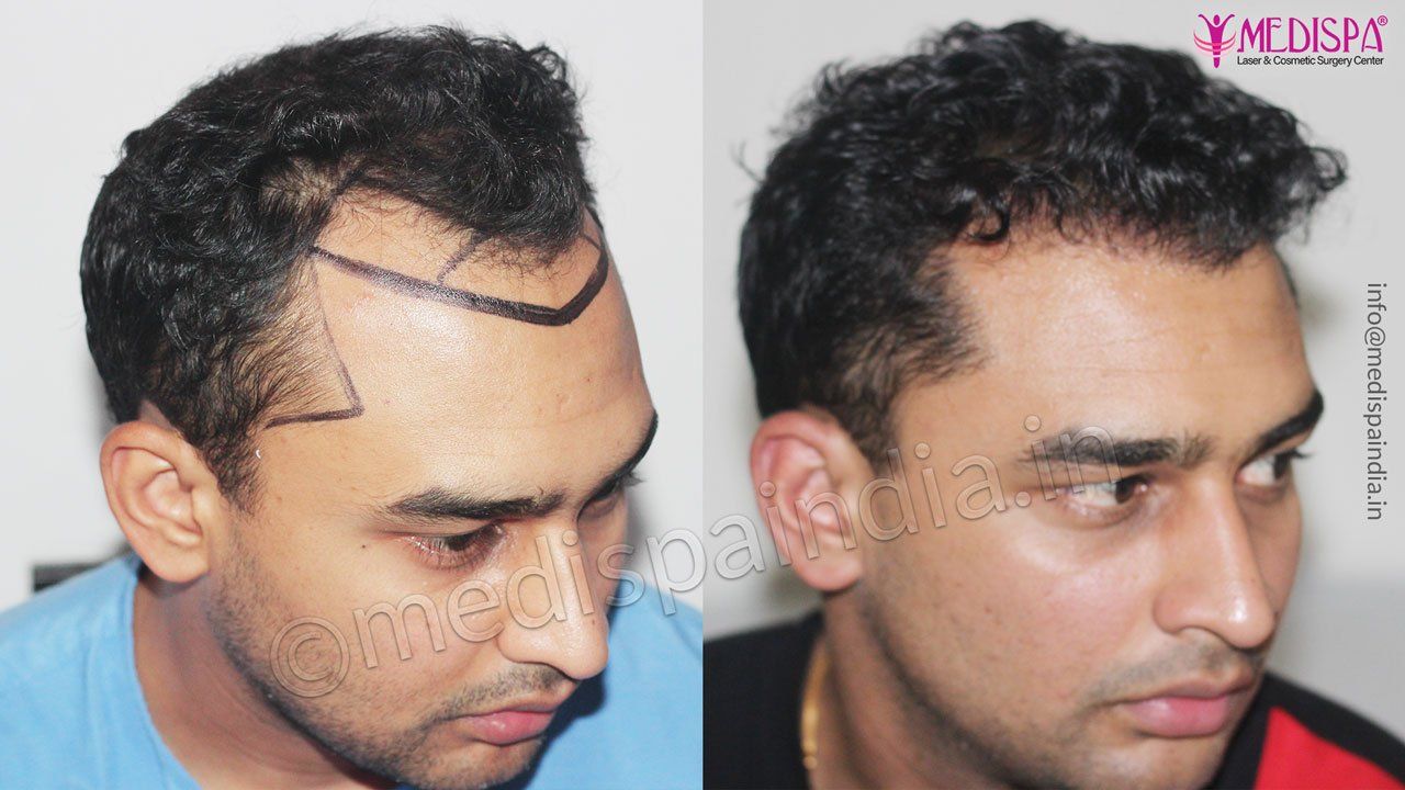 hair transplant mumbai results | Hair Transplant Dubai Cost hair transplant mumbai results | Hair Transplant Dubai Cost