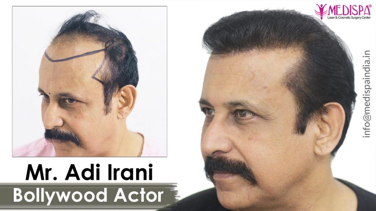 bollywood-celebrity-hair-transplant – Hair Transplant Dubai Cost