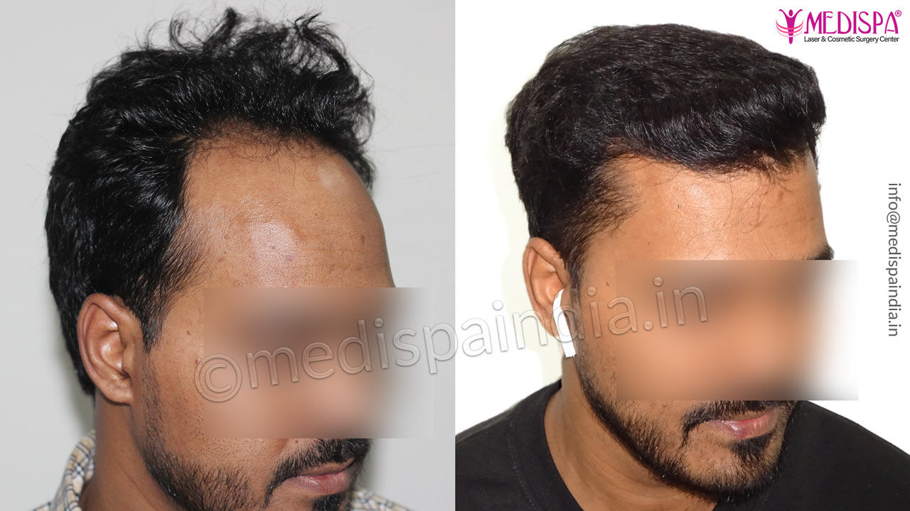 cost-of-hair-transplant-in-delhi – Hair Transplant Dubai Cost cost-of-hair-transplant-in-delhi – Hair Transplant Dubai Cost