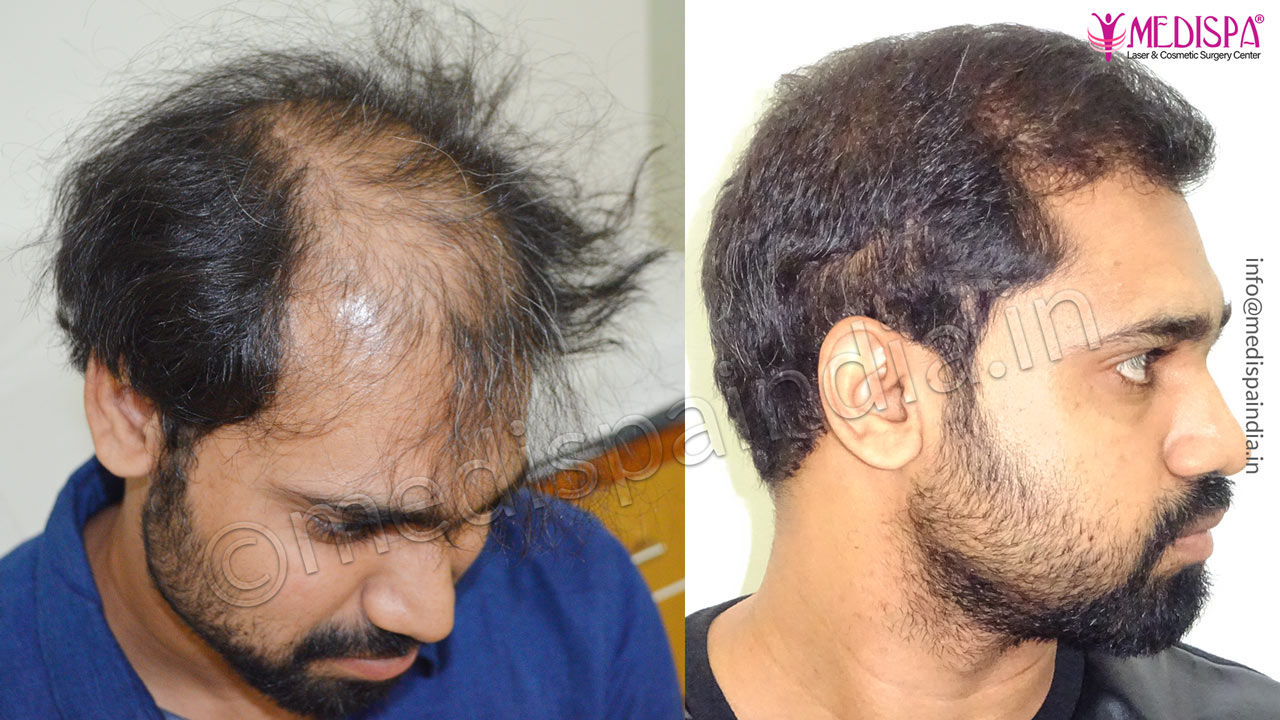 dr-suneet-soni-cost – Hair Transplant Dubai Cost dr-suneet-soni-cost – Hair Transplant Dubai Cost