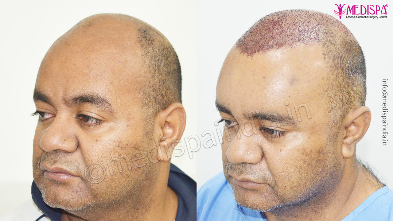 sydney hair transplant result Hair Transplant Dubai Cost