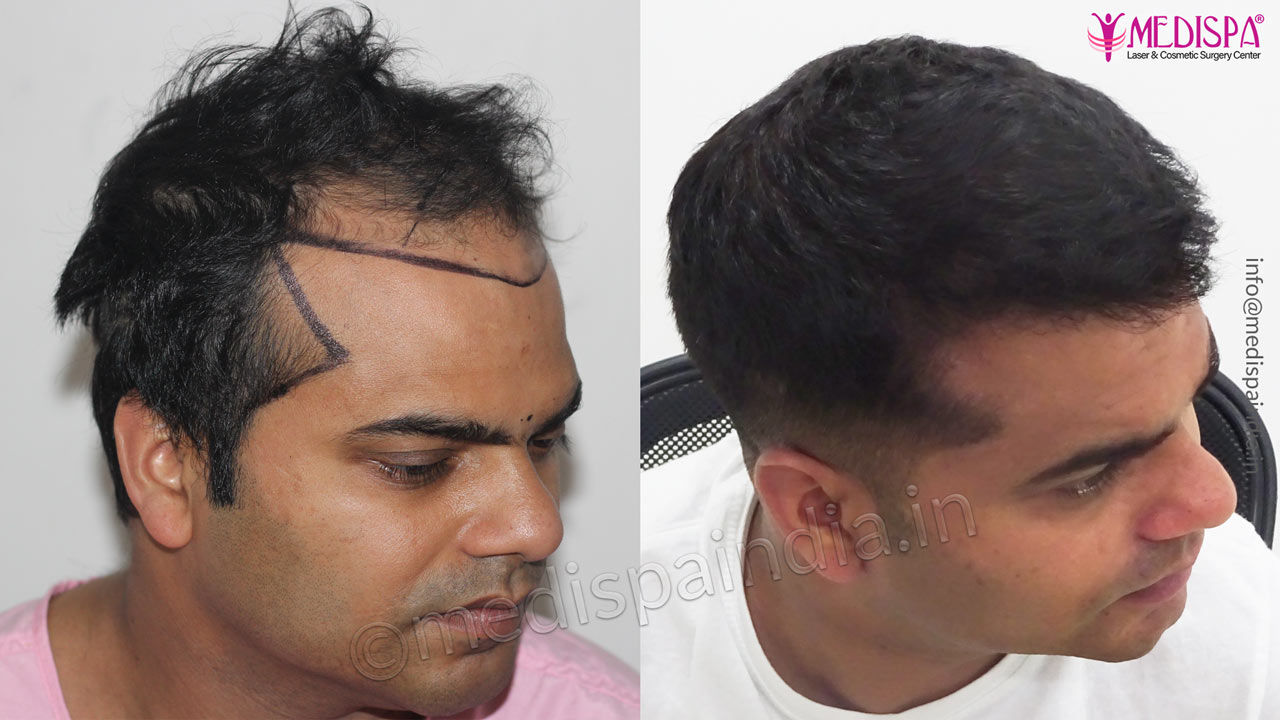 hairtransplantbeforeafterjaipurindia Hair Transplant Dubai Cost