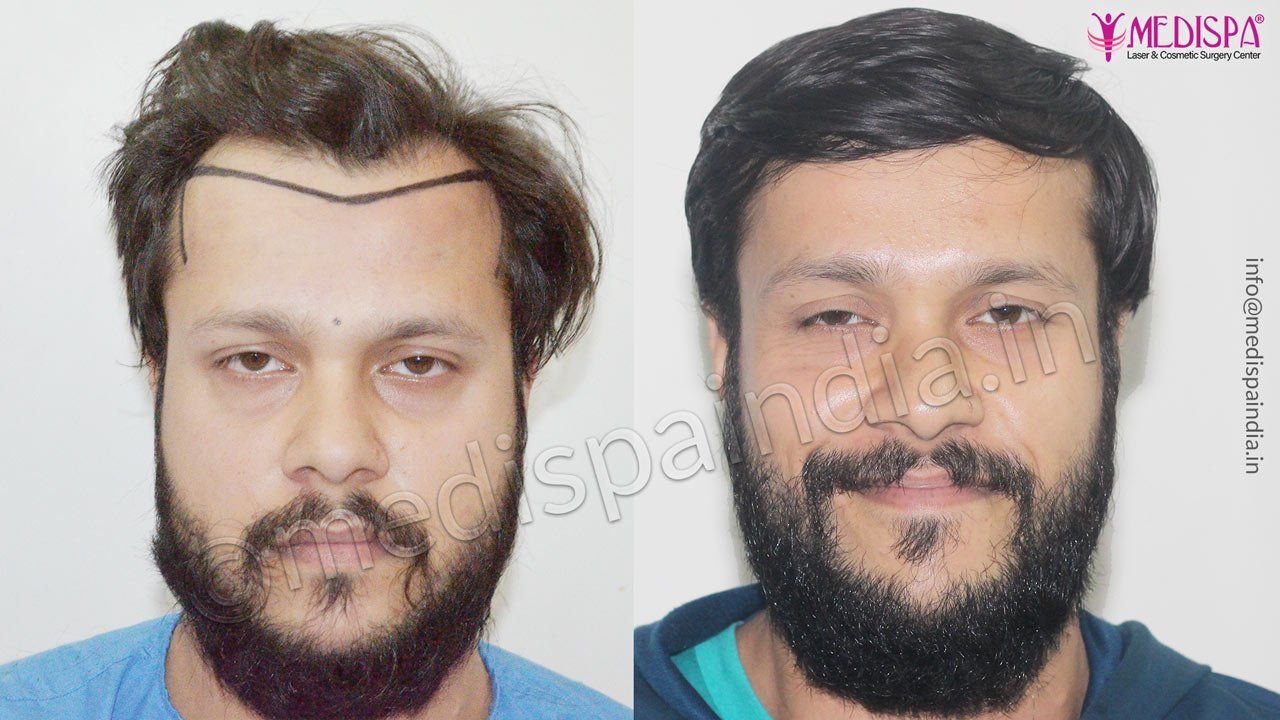 hair-transplant-chandigarh – Hair Transplant Dubai Cost hair-transplant-chandigarh – Hair Transplant Dubai Cost