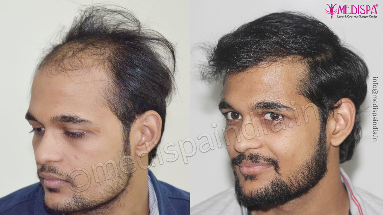 best hair transplant results new delhi | Hair Transplant Dubai Cost best hair transplant results new delhi | Hair Transplant Dubai Cost