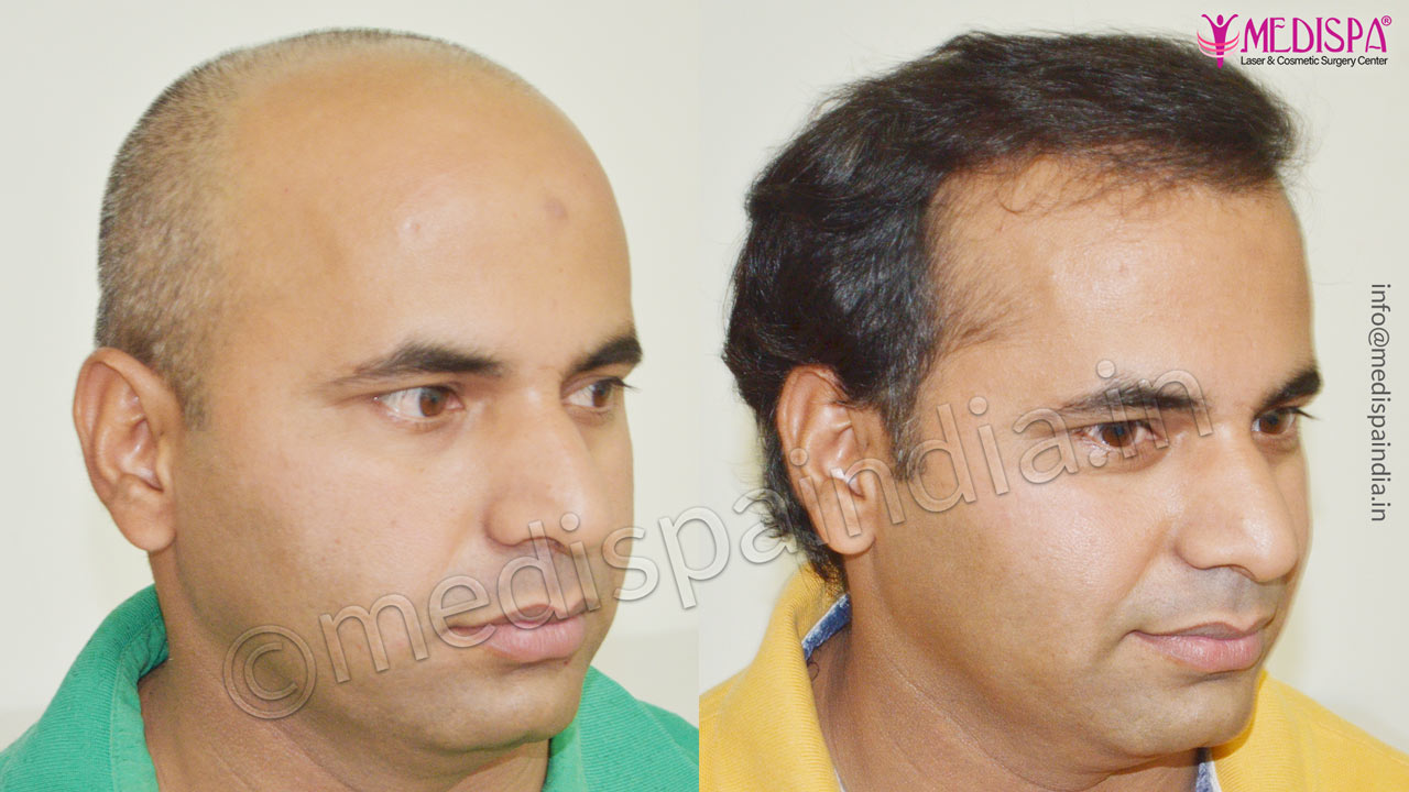 hair-transplant-cost-in-australia_YAJD – Hair Transplant Dubai Cost hair-transplant-cost-in-australia_YAJD – Hair Transplant Dubai Cost