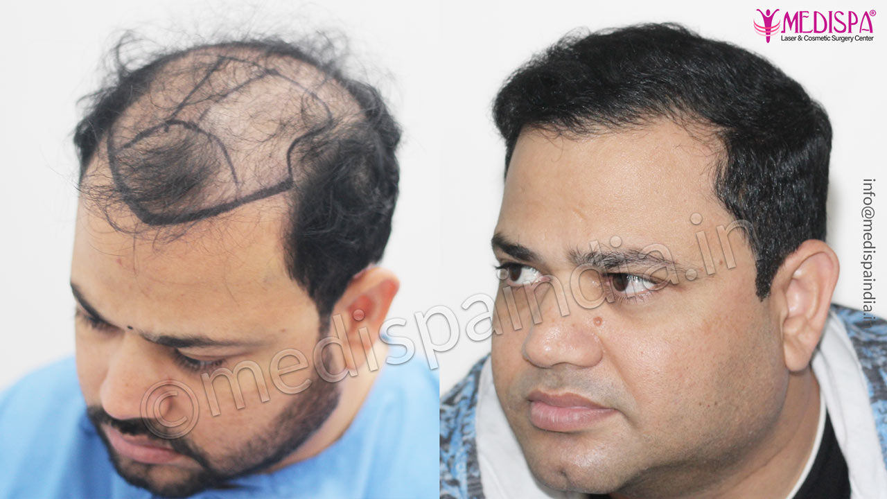 hair-transplant-cost-in-hyderabad – Hair Transplant Dubai Cost hair-transplant-cost-in-hyderabad – Hair Transplant Dubai Cost