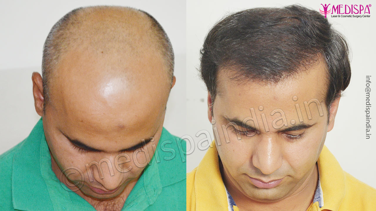 jaipur hair transplant before after results Hair Transplant Dubai Cost