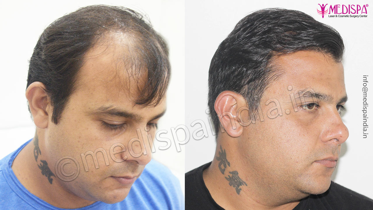 Who Does A Hair Transplant Surgery in Dubai | Dr. Sannia Awais