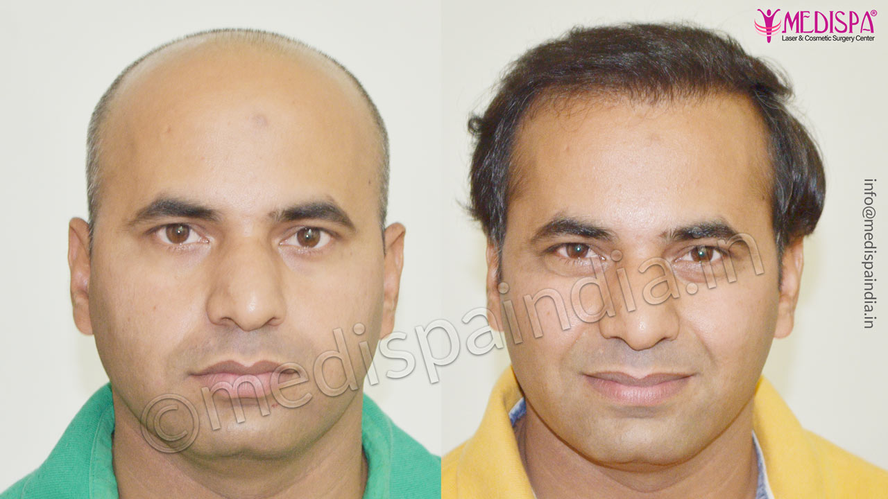 jaipur hair transplant before after results Hair Transplant Dubai Cost