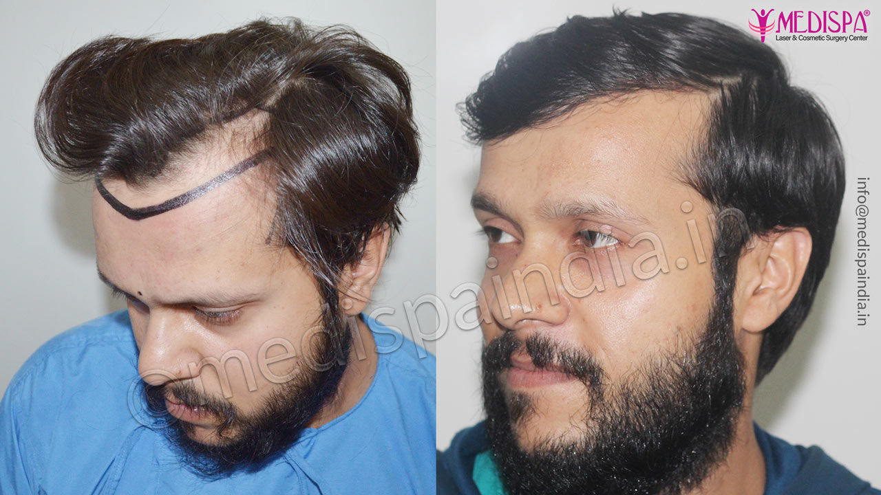 hair-transplant-surgeons-in-chandigarh-india – Hair Transplant Dubai Cost hair-transplant-surgeons-in-chandigarh-india – Hair Transplant Dubai Cost