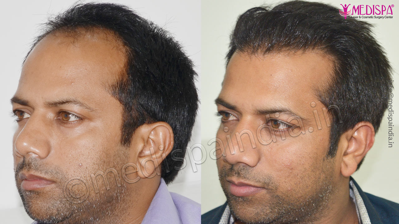 hair-transplant-surgeons-in-gurugram – Hair Transplant Dubai Cost hair-transplant-surgeons-in-gurugram – Hair Transplant Dubai Cost