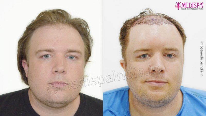 best hair transplant in usa