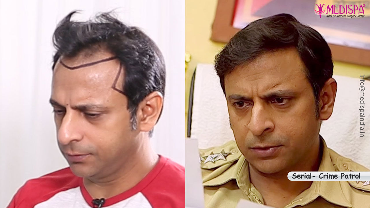 celebrity hair transplant result | Hair Transplant Dubai Cost celebrity hair transplant result | Hair Transplant Dubai Cost