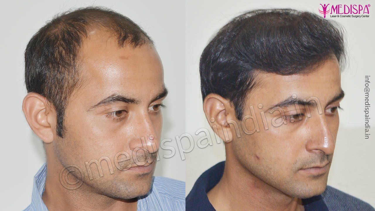 jaipur hair transplant before after result Hair Transplant Dubai Cost