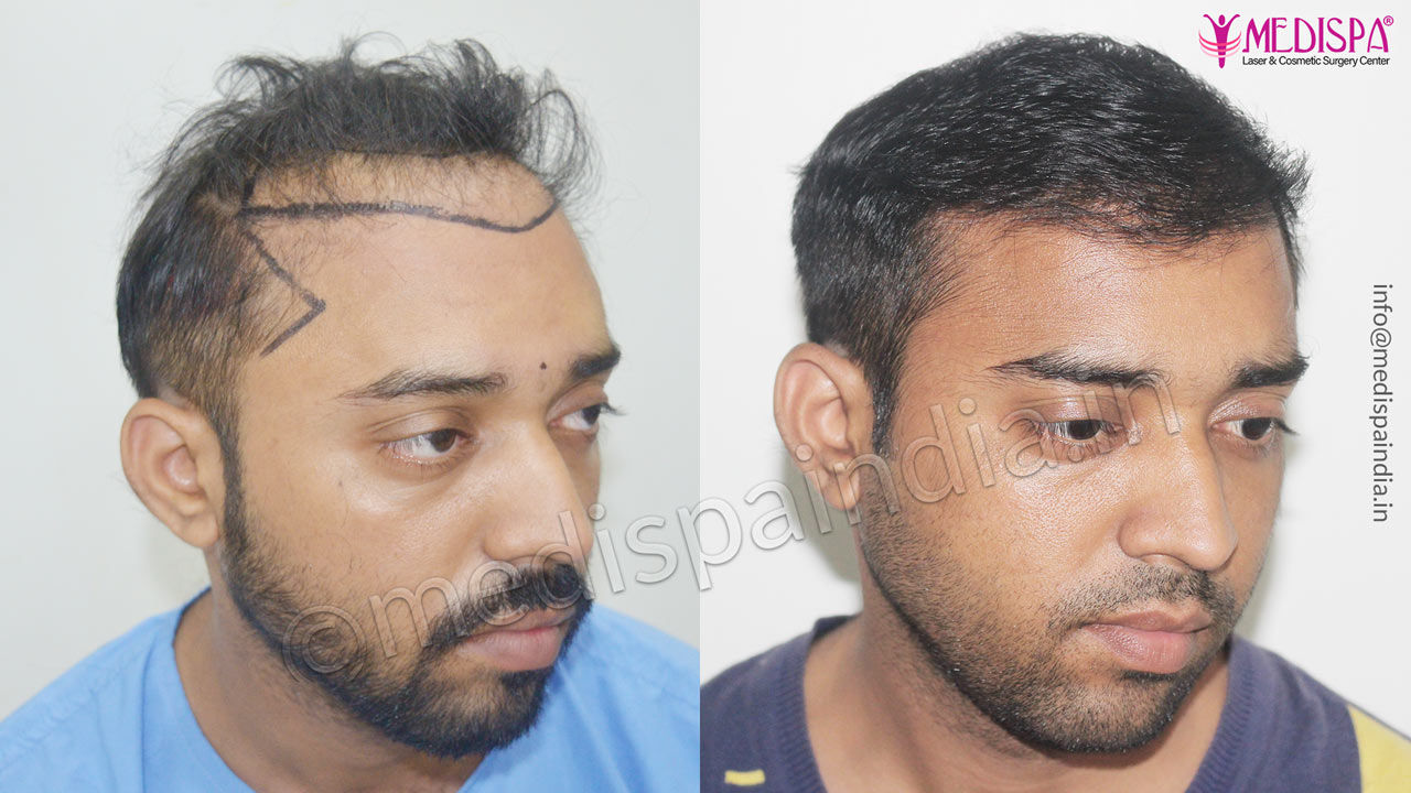 wrong-hair-transplant-correction-in-jaipur – Hair Transplant Dubai Cost