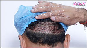 Hair Transplant in Dubai 7900 AED min 5000 Hairs Low Cost Top Clinic  Best Doctors  Cosmocare Dermatologist Dubai