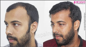 Hair Transplant Dubai Cost | Medispa Hair Transplant Clinic Hair Transplant Dubai Cost | Medispa Hair Transplant Clinic