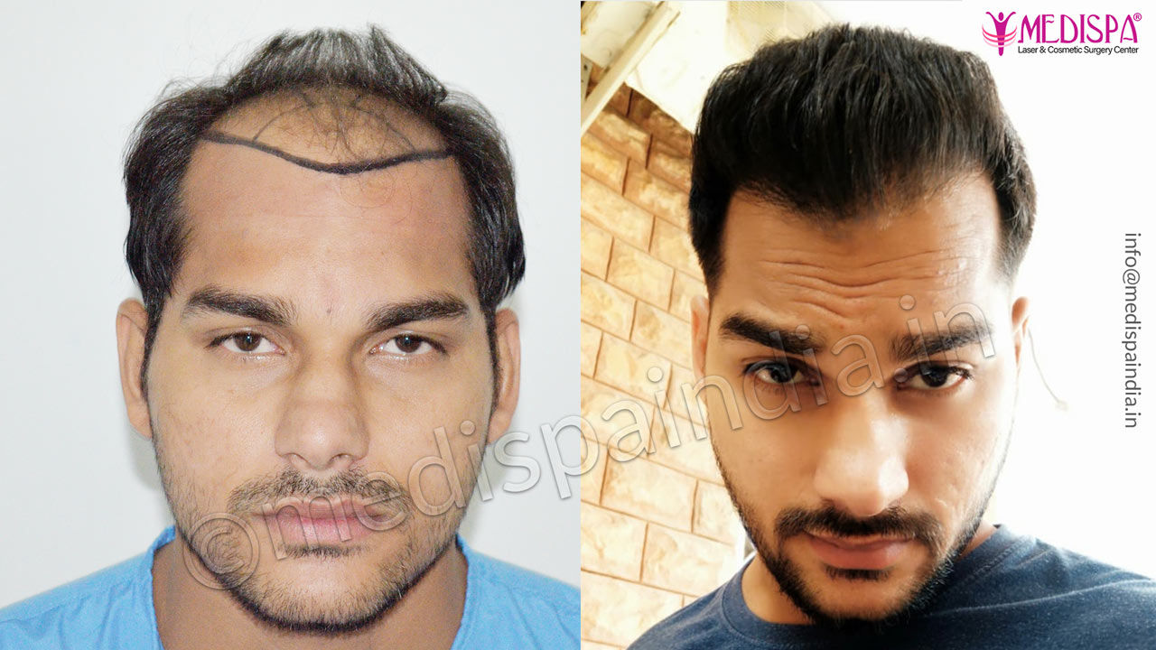before after hair transplant