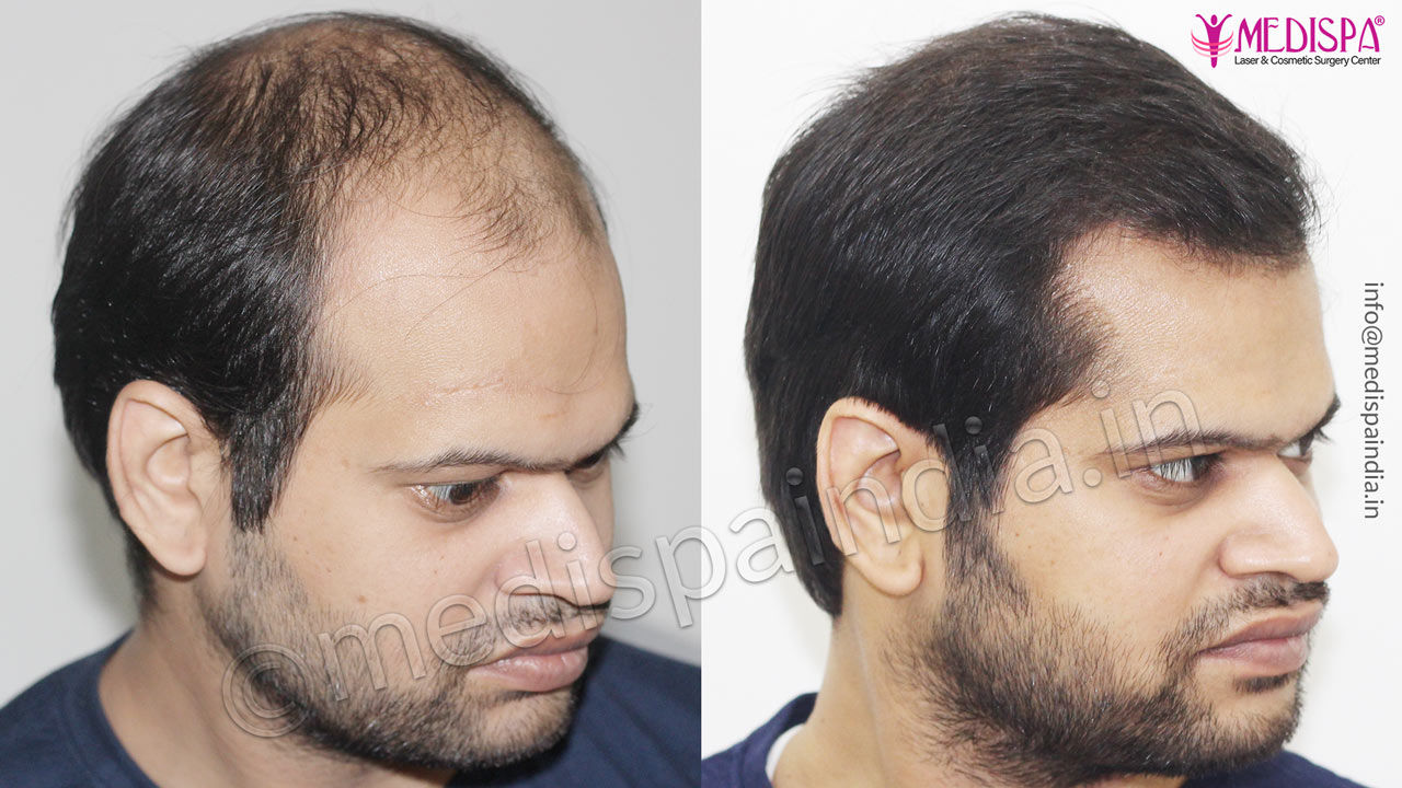 hair transplant clinics in bikaner-rajasthan