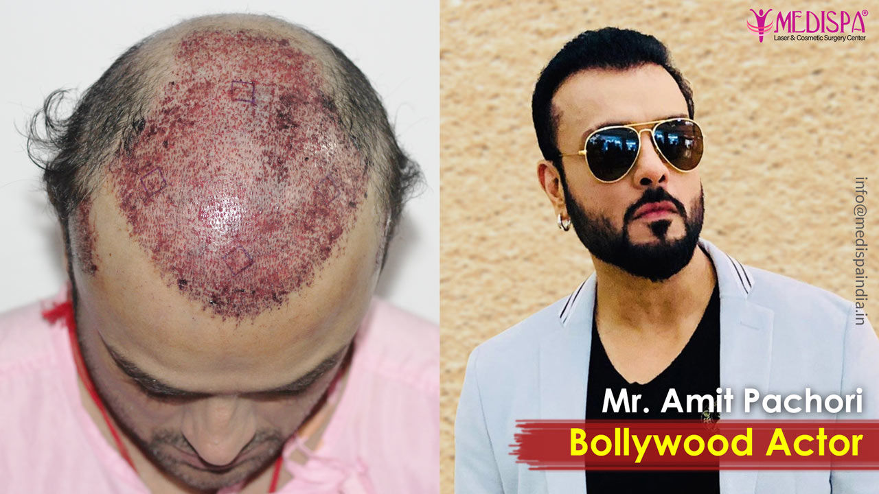 best hair transplant results in india