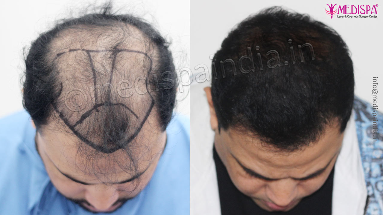 hair transplant jaipur rajasthan