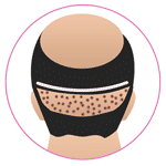 Combine FUT & FUE Hair Transplant in Jodhpur