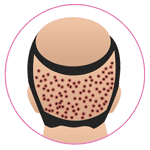 FUE Hair Transplant in Jodhpur 