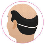 FUT Hair Transplant in Jodhpur