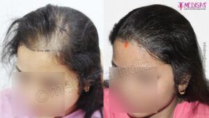 What is The Success Rate For Hair Transplant in Women?