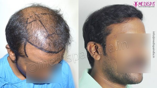 The Ultimate Guide To Facial Hair Transplant
