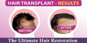 The Ultimate Solution For Hair Loss: Hair Restoration